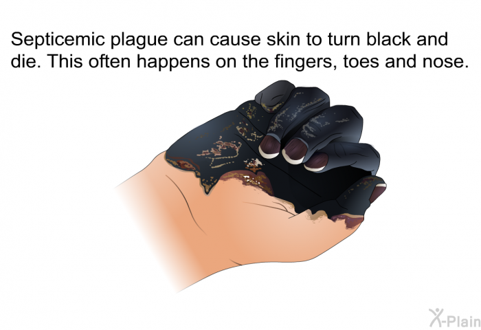 Septicemic plague can cause skin to turn black and die. This often happens on the fingers, toes and nose.