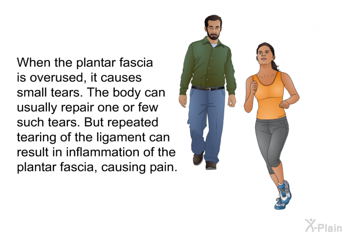 When the plantar fascia is overused, it causes small tears. The body can usually repair one or few such tears. But repeated tearing of the ligament can result in inflammation of the plantar fascia, causing pain.