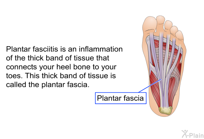 Plantar fasciitis is an inflammation of the thick band of tissue that connects your heel bone to your toes. This thick band of tissue is called the plantar fascia.