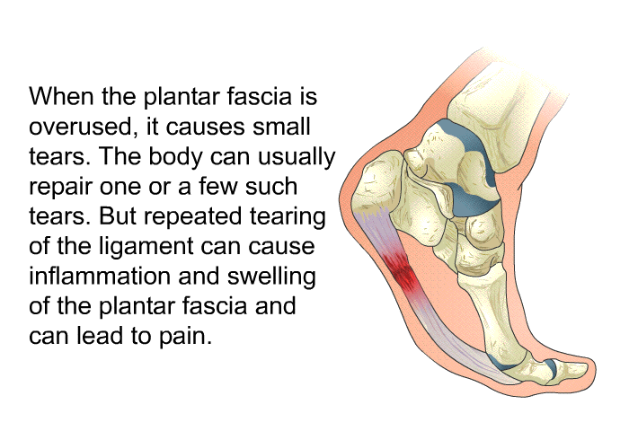 When the plantar fascia is overused, it causes small tears. The body can usually repair one or a few such tears. But repeated tearing of the ligament can cause inflammation and swelling of the plantar fascia and can lead to pain.