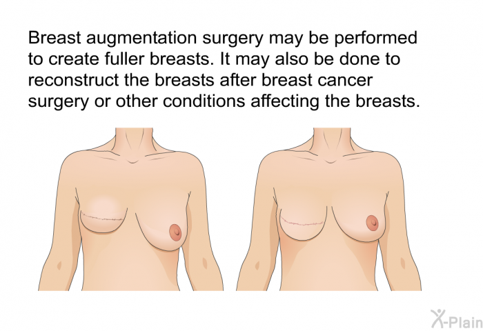 Breast augmentation surgery may be performed to create fuller breasts. It may also be done to reconstruct the breasts after breast cancer surgery or other conditions affecting the breasts.