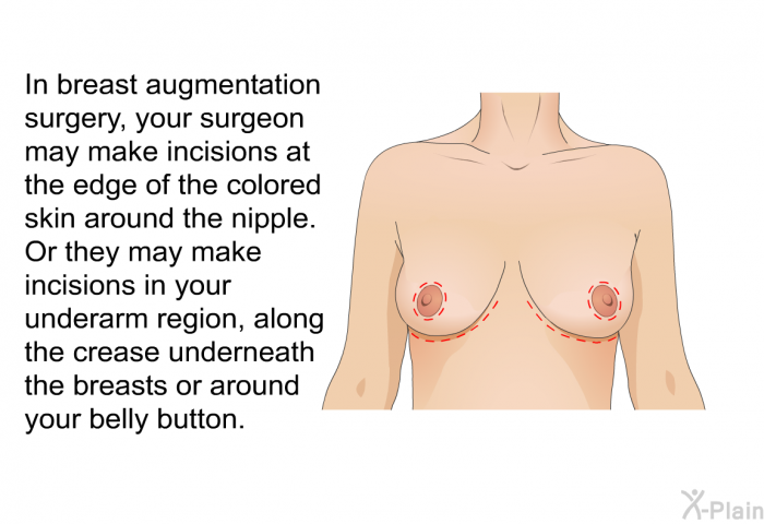 In breast augmentation surgery, your surgeon may make incisions at the edge of the colored skin around the nipple. Or they may make incisions in your underarm region, along the crease underneath the breasts or around your belly button.