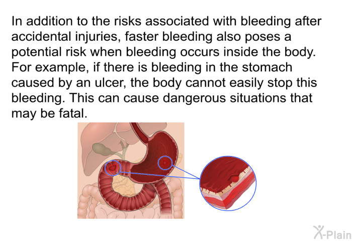 In addition to the risks associated with bleeding after accidental injuries, faster bleeding also poses a potential risk when bleeding occurs inside the body. For example, if there is bleeding in the stomach caused by an ulcer, the body cannot easily stop this bleeding. This can cause dangerous situations that may be fatal.