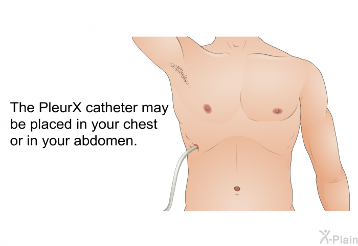 The PleurX catheter may be placed in your chest or in your abdomen.