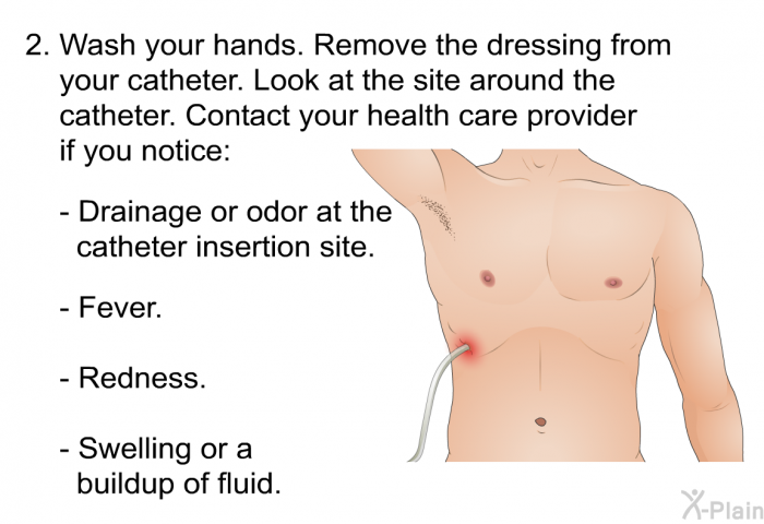 Wash your hands. Remove the dressing from your catheter. Look at the site around the catheter. Contact your health care provider if you notice:   Drainage or odor at the catheter insertion site. Fever. Redness. Swelling or a buildup of fluid.