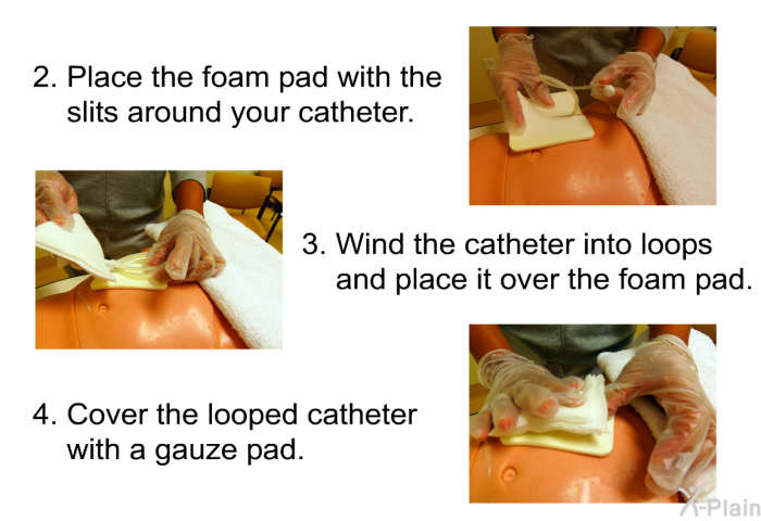 Place the foam pad with the slits around your catheter. Wind the catheter into loops and place it over the foam pad. Cover the looped catheter with a gauze pad.