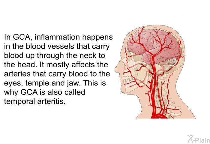 In GCA, inflammation happens in the blood vessels that carry blood up through the neck to the head. It mostly affects the arteries that carry blood to the eyes, temple and jaw. This is why GCA is also called temporal arteritis.