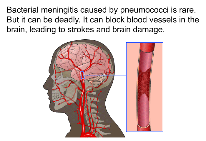 Bacterial meningitis caused by pneumococci is rare. But it can be deadly. It can block blood vessels in the brain, leading to strokes and brain damage.