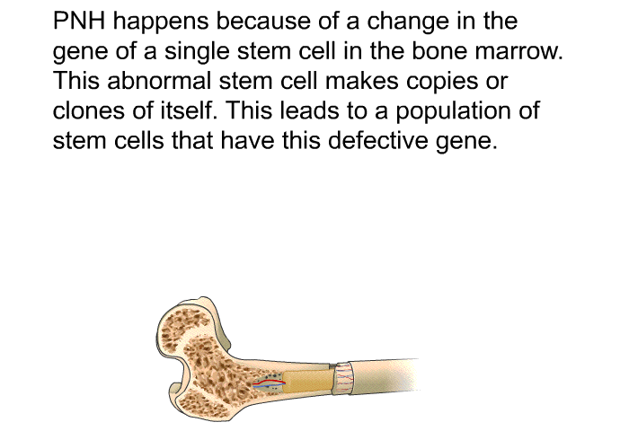 PNH happens because of a change in the gene of a single stem cell in the bone marrow. This abnormal stem cell makes copies or clones of itself. This leads to a population of stem cells that have this defective gene.