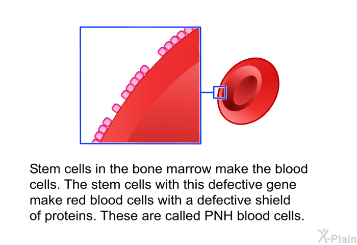 Stem cells in the bone marrow make the blood cells. The stem cells with this defective gene make red blood cells with a defective shield of proteins. These are called PNH blood cells.