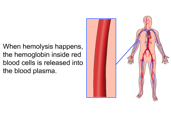 When hemolysis happens, the hemoglobin inside red blood cells is released into the blood plasma.