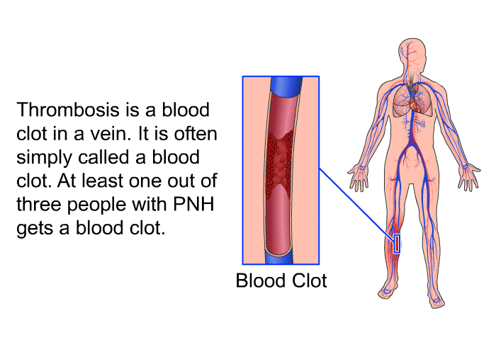 Thrombosis is a blood clot in a vein. It is often simply called a blood clot.<B> </B>At least one out of three people with PNH gets a blood clot.