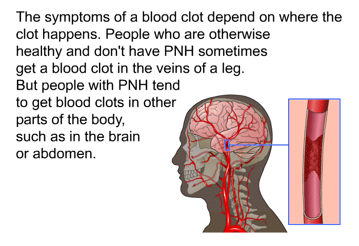 The symptoms of a blood clot depend on where the clot happens. People who are otherwise healthy and don't have PNH sometimes get a blood clot in the veins of a leg. But people with PNH tend to get blood clots in other parts of the body, such as in the brain or abdomen.