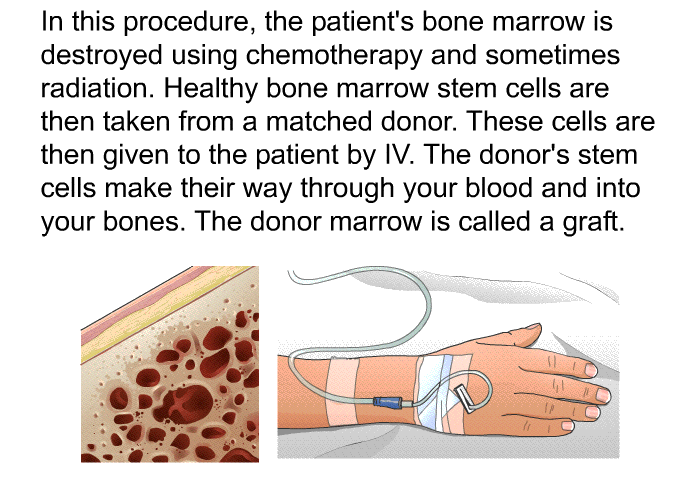 In this procedure, the patient's bone marrow is destroyed using chemotherapy and sometimes radiation. Healthy bone marrow stem cells are then taken from a matched donor. These cells are then given to the patient by IV. The donor's stem cells make their way through your blood and into your bones. The donor marrow is called a graft.
