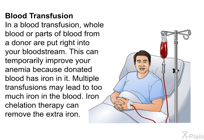 <B>Blood Transfusion:</B> In a blood transfusion, whole blood or parts of blood from a donor are put right into your bloodstream. This can temporarily improve your anemia because donated blood has iron in it. Multiple transfusions may lead to too much iron in the blood. Iron chelation therapy can remove the extra iron.