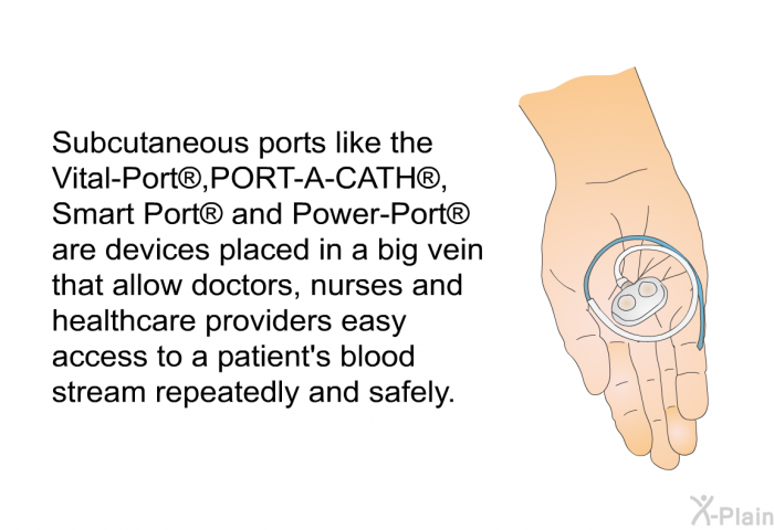 Subcutaneous ports like the Vital-Port, PORT-A-CATH, Smart Port and Power-Port are devices placed in a big vein that allow doctors, nurses and healthcare providers easy access to a patient’s blood stream repeatedly and safely.