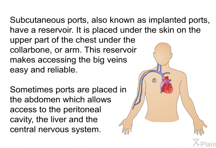 Subcutaneous ports, also known as implanted ports, have a reservoir. It is placed under the skin on the upper part of the chest under the collarbone, or arm. This reservoir makes accessing the big veins easy and reliable. Sometimes ports are placed in the abdomen which allows access to the peritoneal cavity, the liver and the central nervous system.