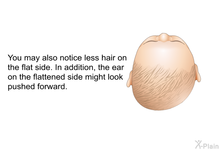 You may also notice less hair on the flat side. In addition, the ear on the flattened side might look pushed forward.