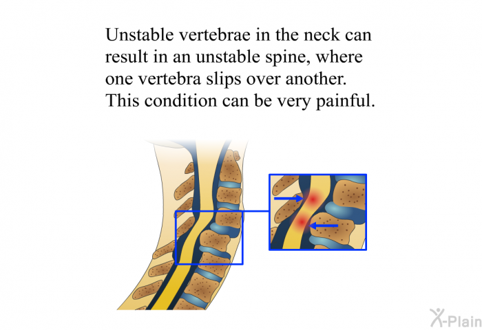 Unstable vertebrae in the neck can result in an unstable spine, where one vertebra slips over another. This condition can be very painful.
