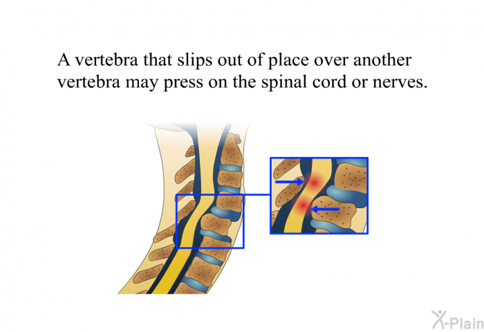 A vertebra that slips out of place over another vertebra may press on the spinal cord or nerves.