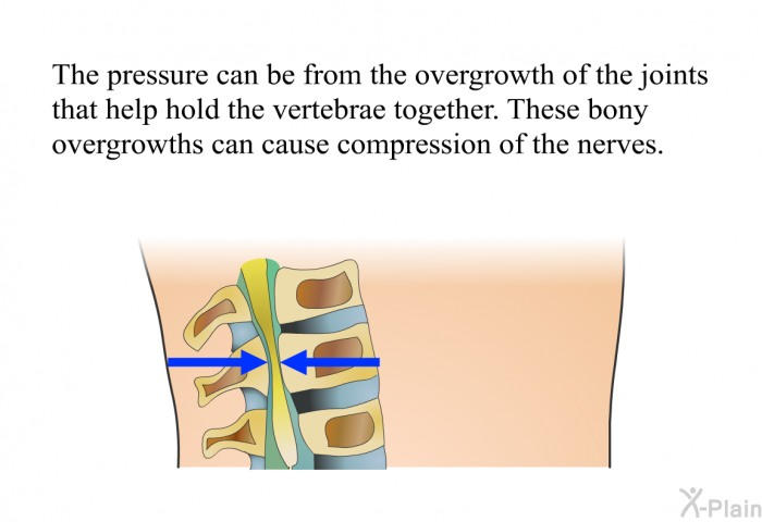The pressure can be from the overgrowth of the joints that help hold the vertebrae together. These bony overgrowths can cause compression of the nerves.