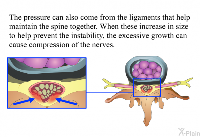 The pressure can also come from the ligaments that help maintain the spine together. When these increase in size to help prevent the instability, the excessive growth can cause compression of the nerves.