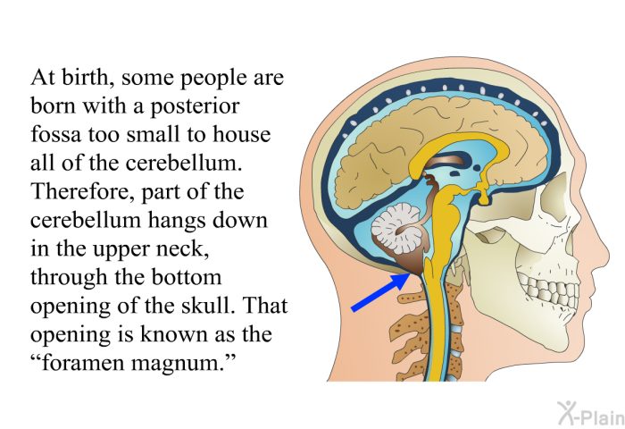 At birth, some people are born with a posterior fossa too small to house all of the cerebellum. Therefore, part of the cerebellum hangs down in the upper neck, through the bottom opening of the skull. That opening is known as the “foramen magnum.”