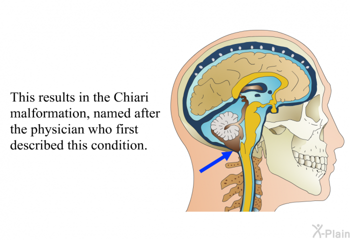This results in the Chiari malformation, named after the physician who first described this condition.