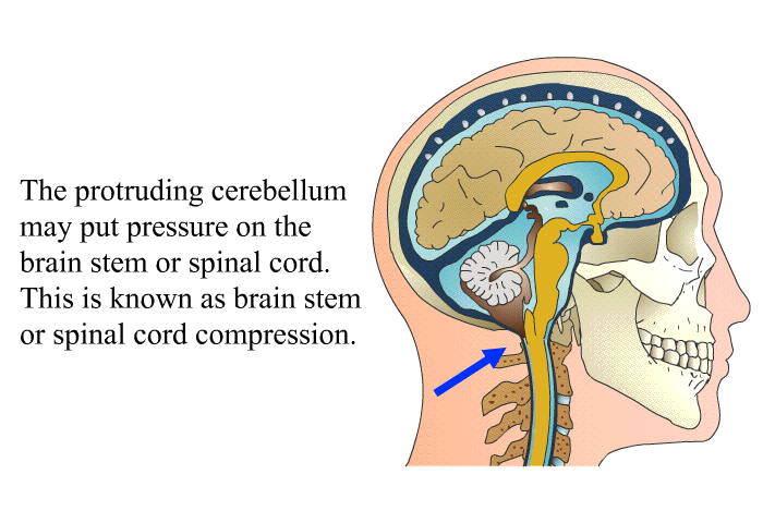 The protruding cerebellum may put pressure on the brain stem or spinal cord. This is known as brain stem or spinal cord compression.