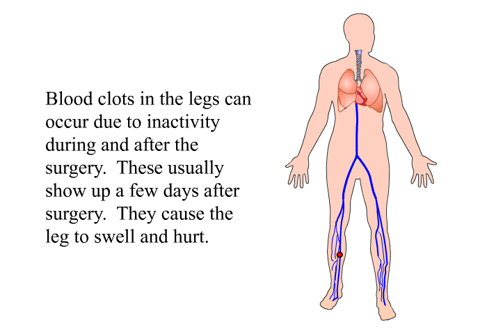 Blood clots in the legs can occur due to inactivity during and after the surgery. These usually show up a few days after surgery. They cause the leg to swell and hurt.