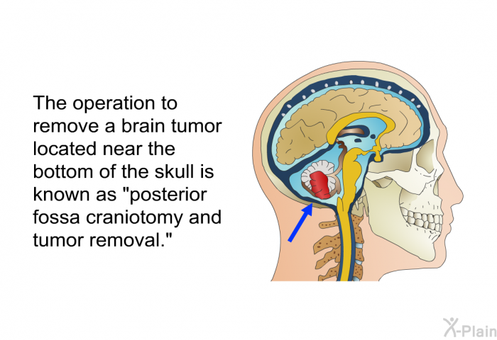 The operation to remove a brain tumor located near the bottom of the skull is known as “posterior fossa craniotomy and tumor removal.”