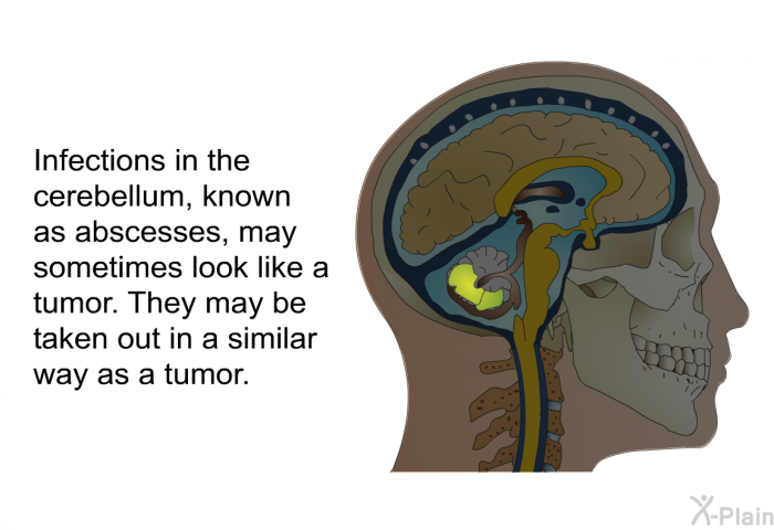 Infections in the cerebellum, known as abscesses, may sometimes look like a tumor. They may be taken out in a similar way as a tumor.