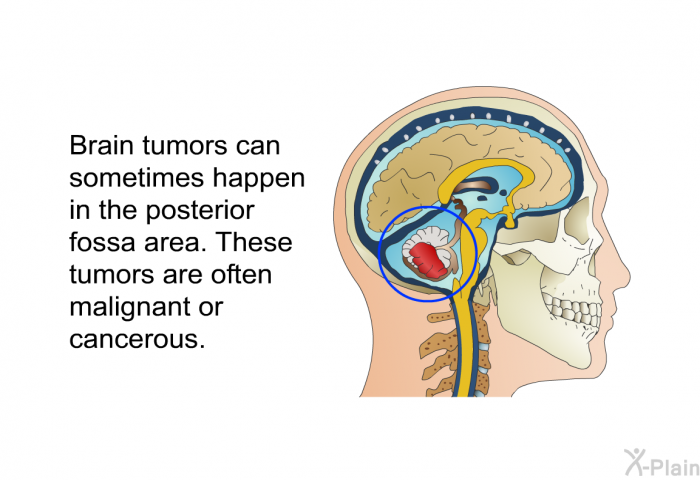 Brain tumors can sometimes happen in the posterior fossa area. These tumors are often malignant or cancerous.