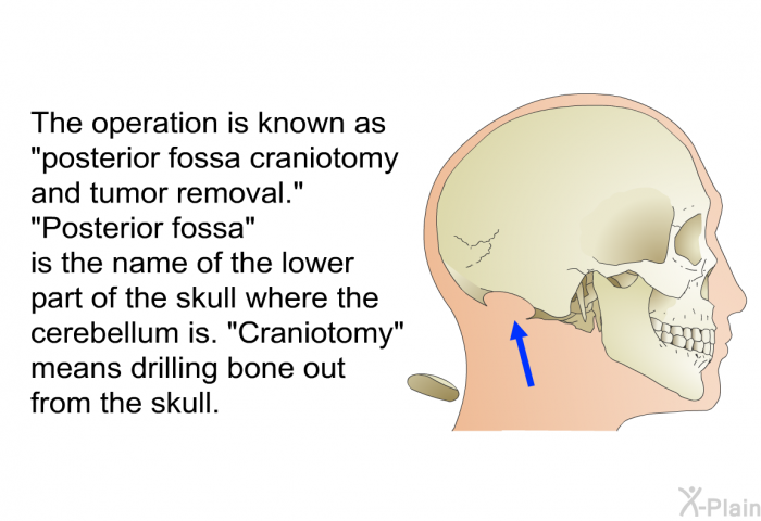 The operation is known as &ldquo;posterior fossa craniotomy and tumor removal.&rdquo; &ldquo;Posterior fossa&rdquo; is the name of the lower part of the skull where the cerebellum is. &ldquo;Craniotomy&rdquo; means drilling bone out from the skull.