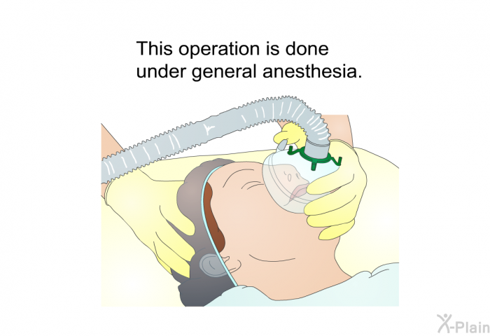 This operation is done under general anesthesia.