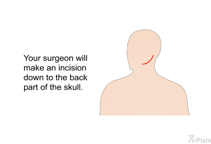 Your surgeon will make an incision down to the back part of the skull.