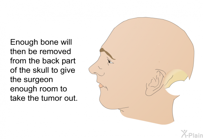 Enough bone will then be removed from the back part of the skull to give the surgeon enough room to take the tumor out.