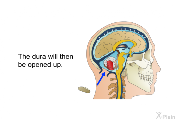The dura will then be opened up.