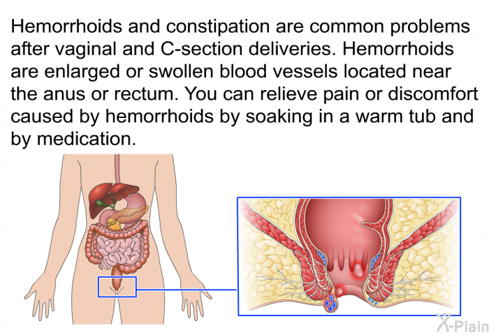Hemorrhoids and constipation are common problems after vaginal and C-section deliveries. Hemorrhoids are enlarged or swollen blood vessels located near the anus or rectum. You can relieve pain or discomfort caused by hemorrhoids by soaking in a warm tub and by medication.