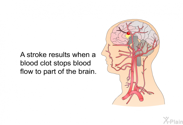 A stroke results when a blood clot stops blood flow to part of the brain.