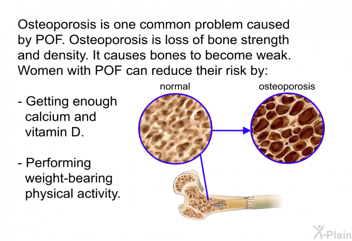 Osteoporosis is one common problem caused by POF. Osteoporosis is a loss of bone strength and density. It causes bones to become weak. Women with POF can reduce their risk by:  Getting enough calcium and vitamin D. Performing weight-bearing physical activity.