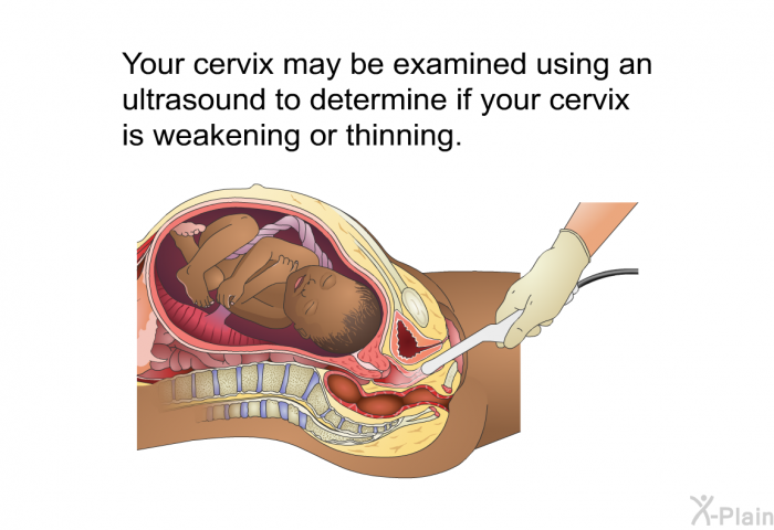 Your cervix may be examined using an ultrasound to determine if your cervix is weakening or thinning.