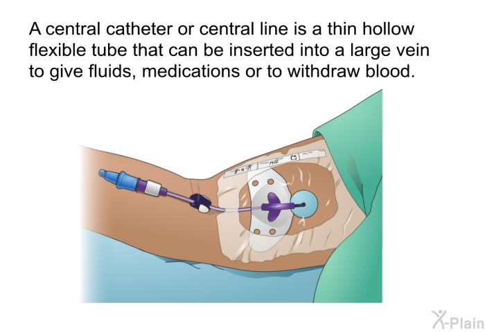 A central catheter or central line is a thin hollow flexible tube that can be inserted into a large vein to give fluids, medications or to withdraw blood.