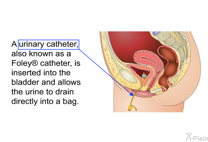 A urinary catheter, also known as a Foley  catheter, is inserted into the bladder and allows the urine to drain directly into a bag.