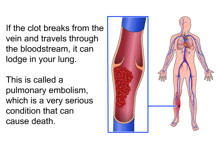 If the clot breaks from the vein and travels through your bloodstream, it can lodge in your lung. This is called a pulmonary embolism, which is a very serious condition that can cause death.