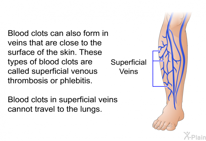 Blood clots can also form in veins that are close to the surface of the skin. These types of blood clots are called superficial venous thrombosis or phlebitis. Blood clots in superficial veins cannot travel to the lungs.
