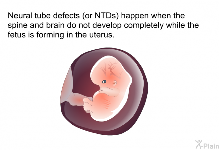 Neural tube defects (or NTDs) happen when the spine and brain do not develop completely while the fetus is forming in the uterus.