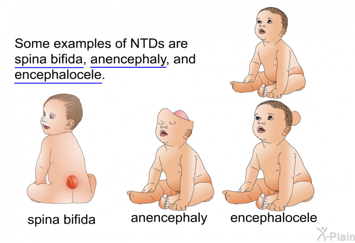 Some examples of NTDs are spina bifida, anencephaly, and encephalocele.