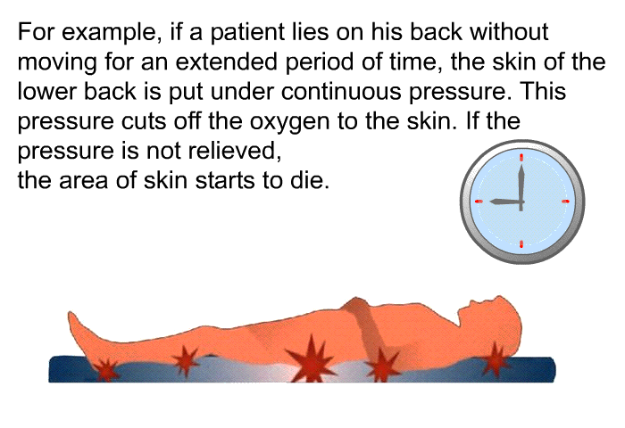 For example, if a patient lies on his back without moving for an extended period of time, the skin of the lower back is put under continuous pressure. This pressure cuts off the oxygen to the skin. If the pressure is not relieved, the area of skin starts to die.