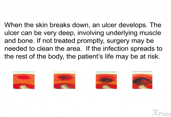 When the skin breaks down, an ulcer develops. The ulcer can be very deep, involving underlying muscle and bone. If not treated promptly, surgery may be needed to clean the area. If the infection spreads to the rest of the body, the patient’s life may be at risk.